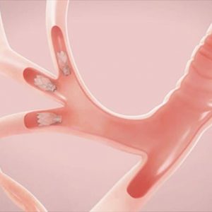 Bronchoscopic Lung Volume Reduction with Zephyr EBV 10.30am