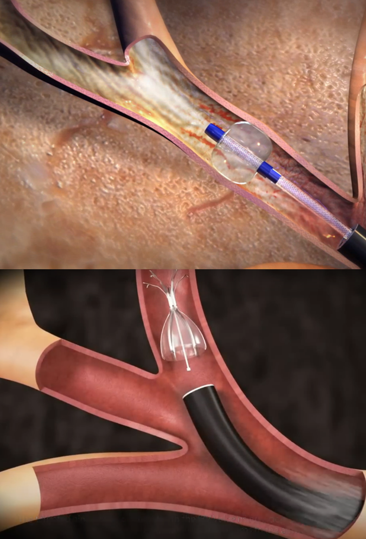 IP Fellowship: BLVR for emphysaema 11.00am